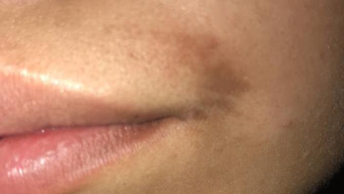 Ok I posted a post where I burned my lip with some wax strips and I think it’s healing but will this take off if yes how long?