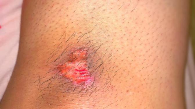 How to treat a grazed knee?