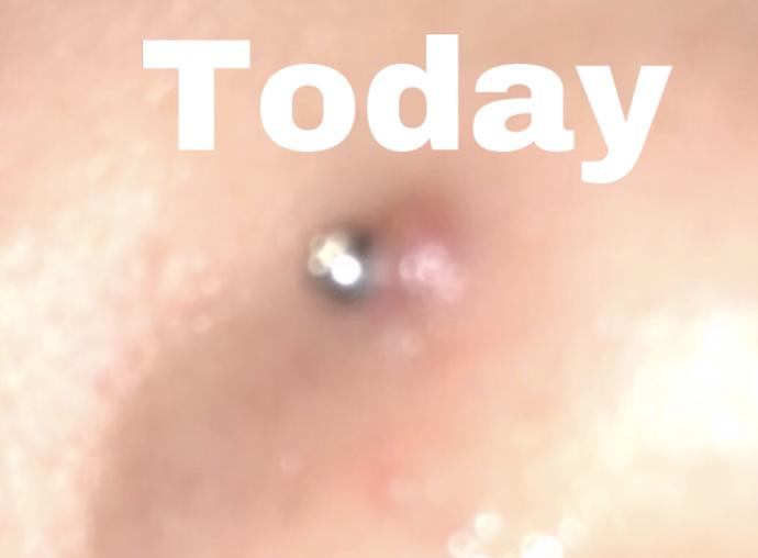 This bump appeared on my nose piercing. What is it and how do I get rid of it?