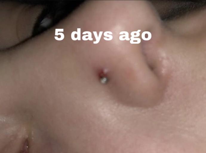 This bump appeared on my nose piercing. What is it and how do I get rid of it?