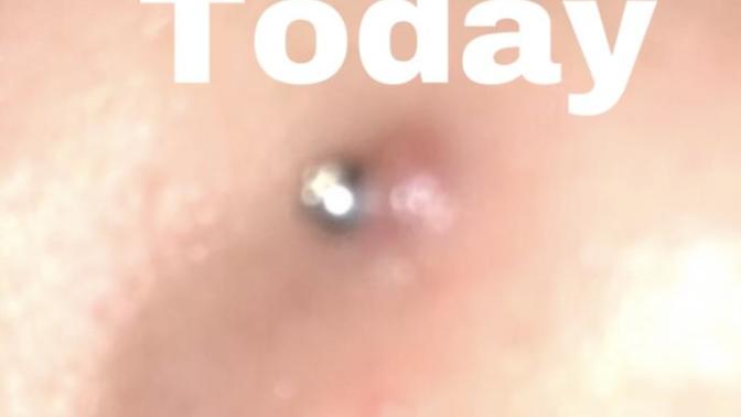 This bump appeared on my nose piercing. What is it and how do I get rid of it?