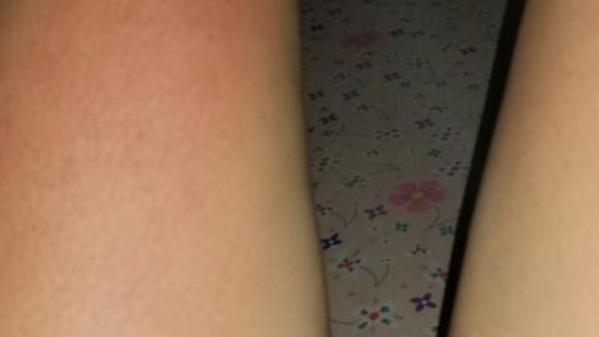 How to treat a sunburn? How bad is it?