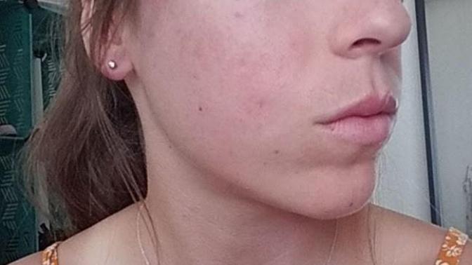 How Bad are my Acne Scars?