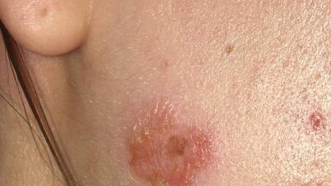 Circle of skin missing from my face skin, what is this?