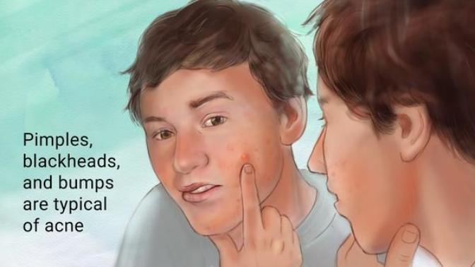 If a person is good looking with acne, does it take away from their attraction?