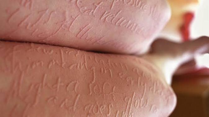 Who has this skin condition?
