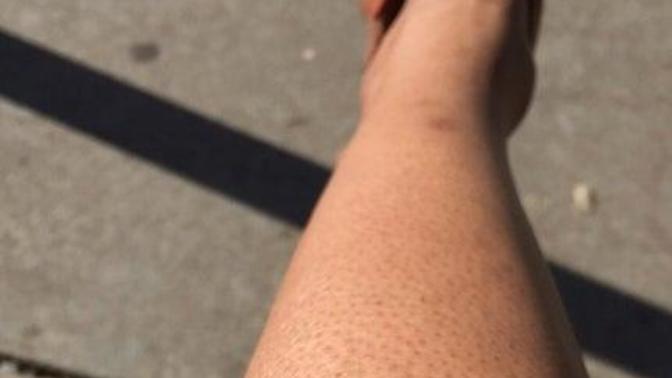 Are strawberry legs ugly or a turn off for you?
