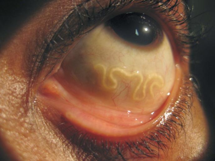 The eye worm