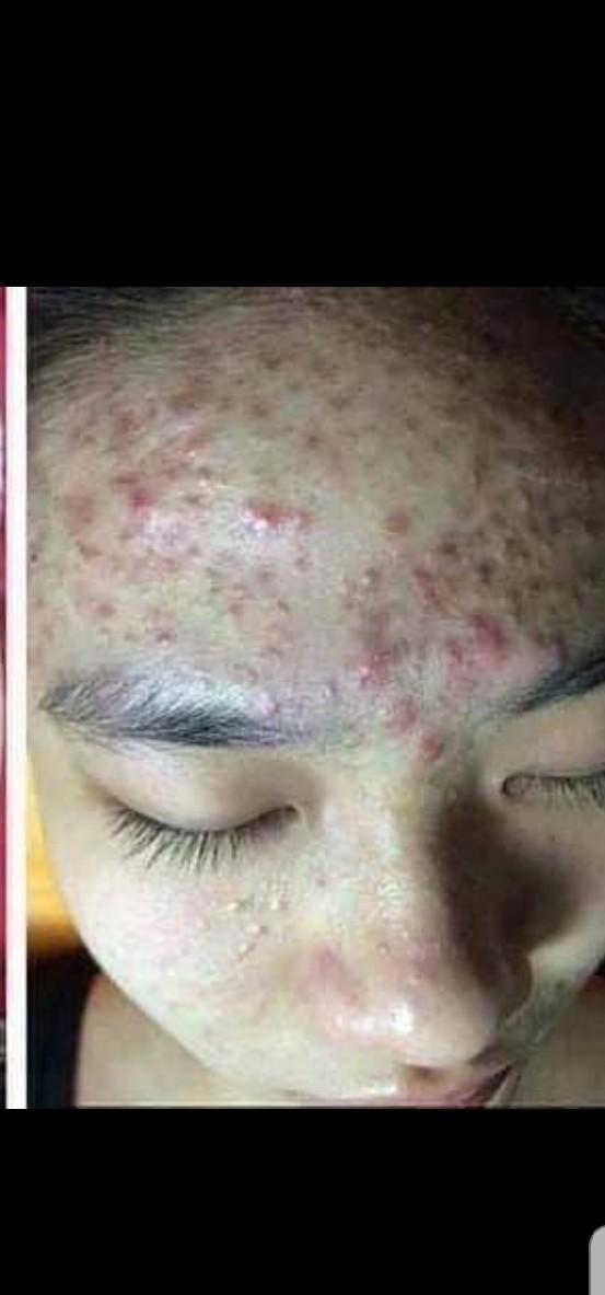 True or false: people with a lot of acne are dirty?