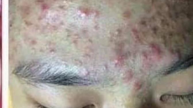True or false: people with a lot of acne are dirty?