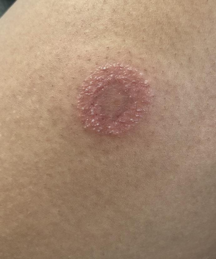What is this? a bite? allergic reaction?
