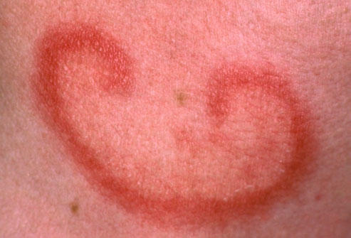 What is this? a bite? allergic reaction?