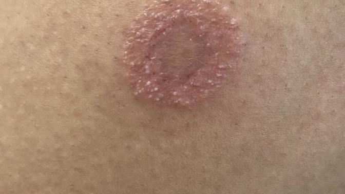 What is this? a bite? allergic reaction?