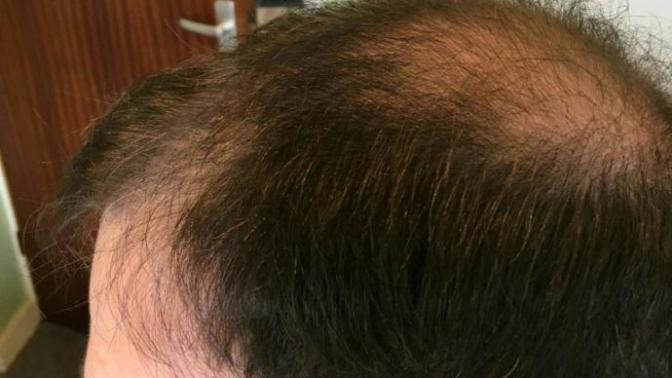 I started losing my hair about 5 years ago and am thinning up top. Is this something girls find unattractive?