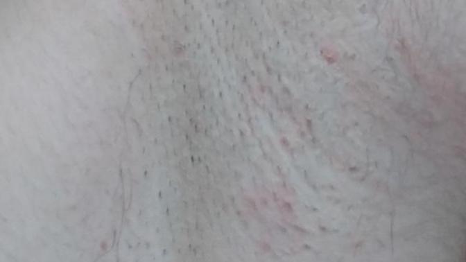 Girls, is this normal after shaving?