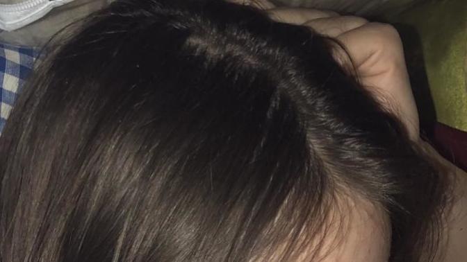 Am I bolding? My hair is thinning?