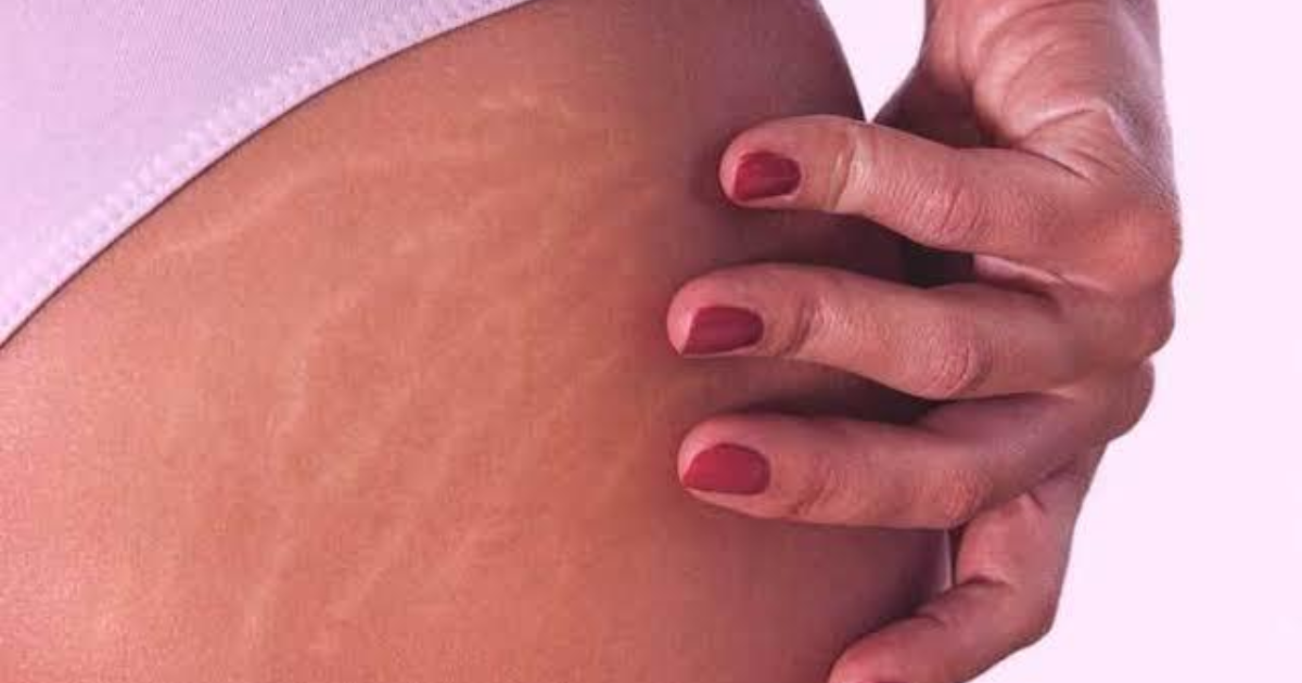 Why are stretch marks seen as a flaw? - GirlsAskGuys