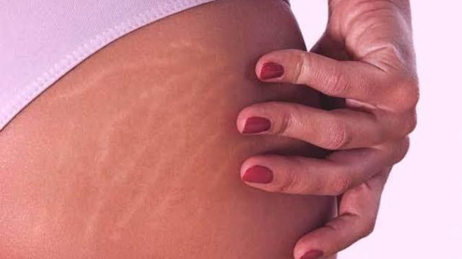 Why are stretch marks seen as a flaw?