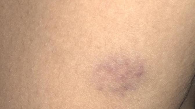 My boyfriends neighbors dog bit me on the back of my leg last night. it didn’t break skin or bleed but it did swell, and I just noticed these bruises?