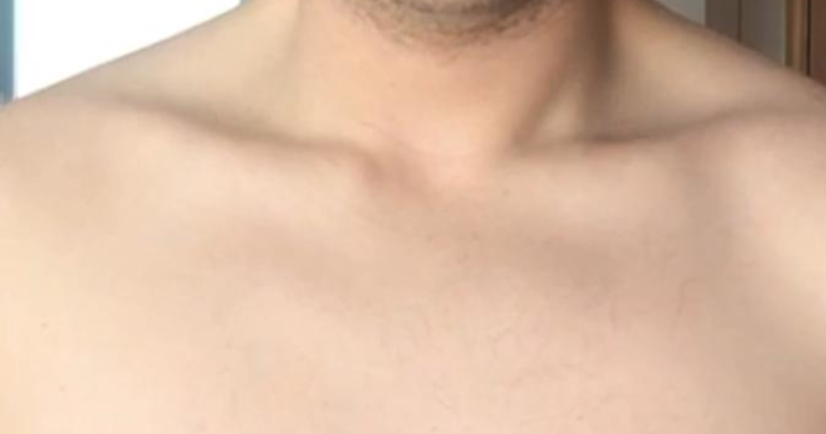 Would you date someone who has chest scars like mine from weight loss surgery? (Image attached