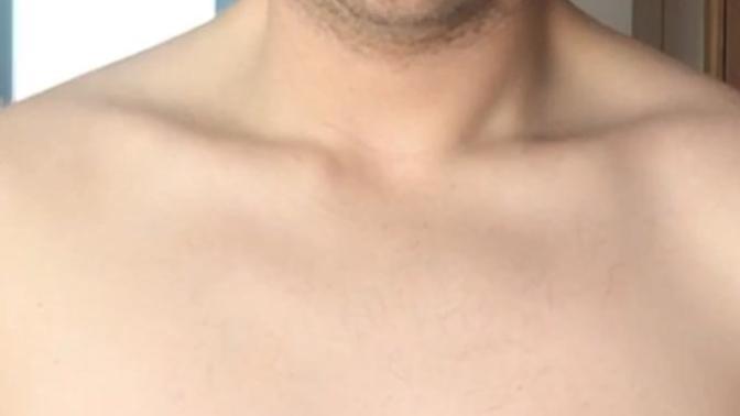 Would you date someone who has chest scars like mine from weight loss surgery? (Image attached)?