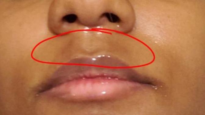 Dark marks on my upper lip?