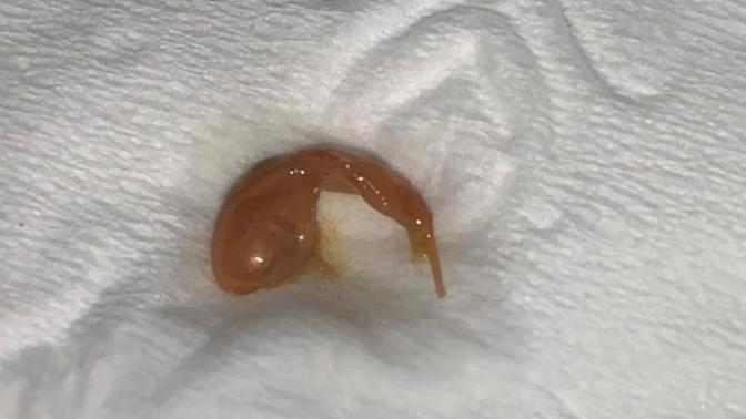 Miscarriage or something else?