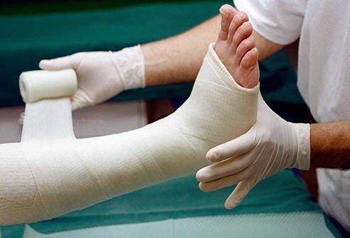 Have you ever broken a bone? If so which one?