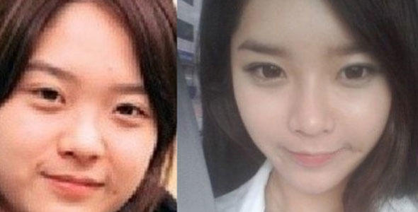 New Asian Eye-Widening Fad in Plastic Surgery! Do you like it?
