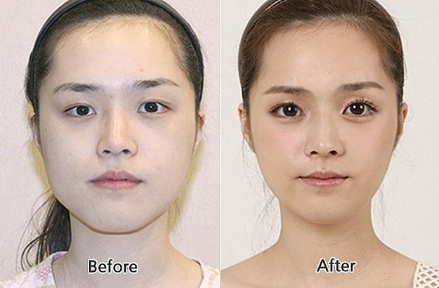 New Asian Eye-Widening Fad in Plastic Surgery! Do you like it?