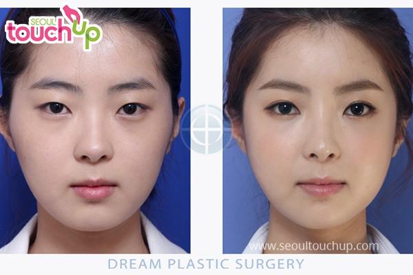 New Asian Eye-Widening Fad in Plastic Surgery! Do you like it?