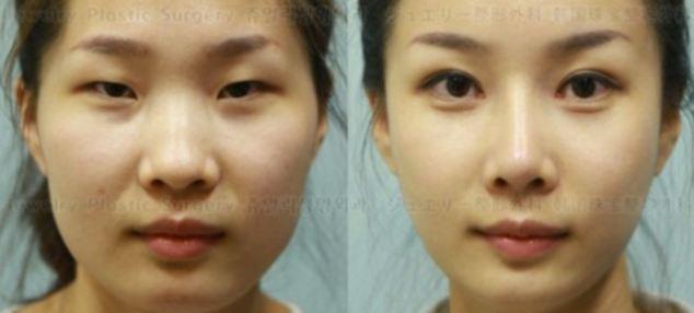 New Asian Eye-Widening Fad in Plastic Surgery! Do you like it?
