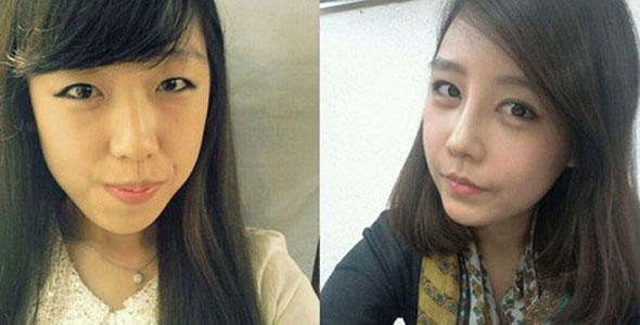 New Asian Eye-Widening Fad in Plastic Surgery! Do you like it?