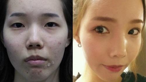 New Asian Eye-Widening Fad in Plastic Surgery! Do you like it?