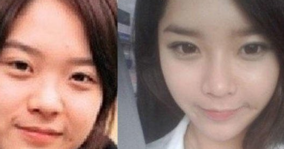 New Asian EyeWidening Fad in Plastic Surgery! Do you like it