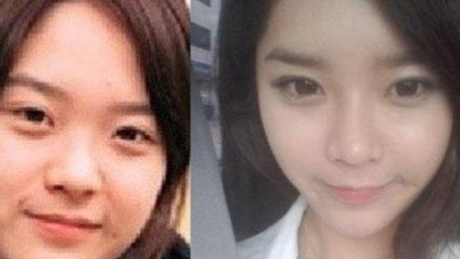 New Asian Eye-Widening Fad in Plastic Surgery! Do you like it?