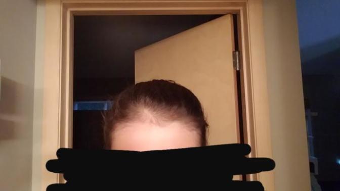Bald spot at 16... what to do?