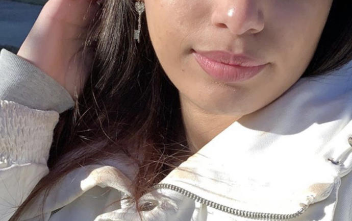 Is it normal to have these fine lines around my mouth at age 18?
