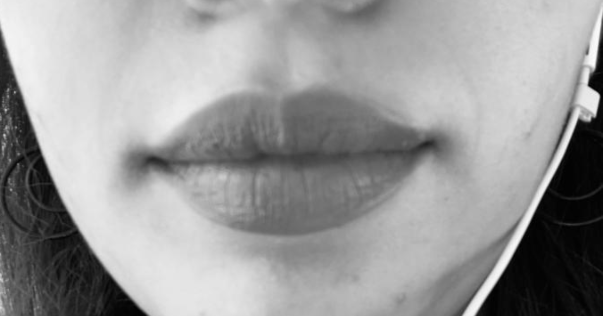 Is it normal to have these fine lines around my mouth at age 18