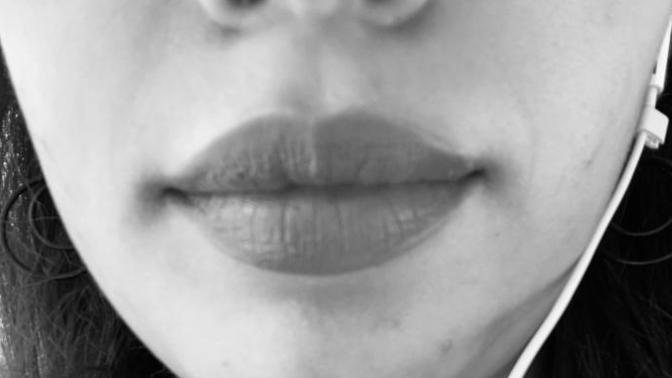 Is it normal to have these fine lines around my mouth at age 18?