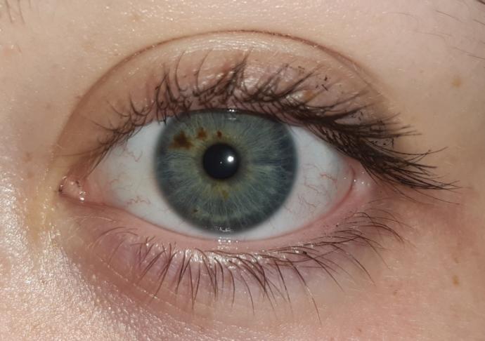 Brown marks in your eyes?
