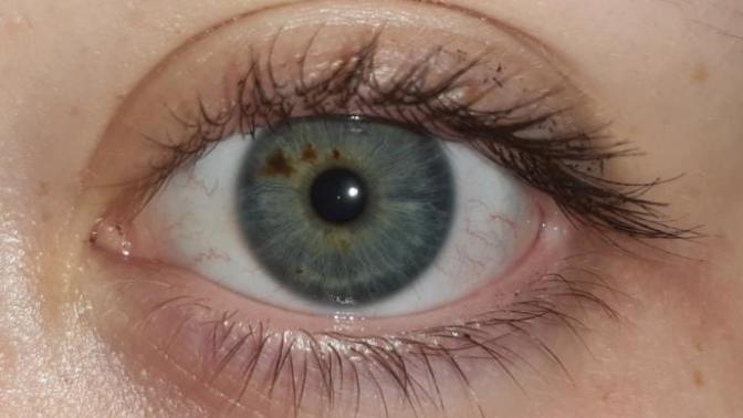 Brown marks in your eyes?