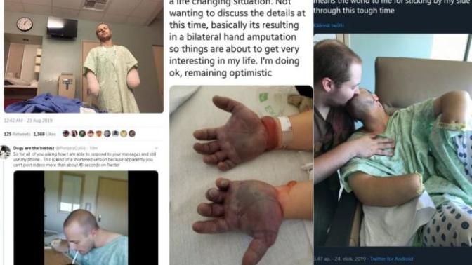 Furry enthusiast destroys hands with dry ice to get them replaced with artificial paws to live out ultimate fantasy with boyfriend, thoughts?