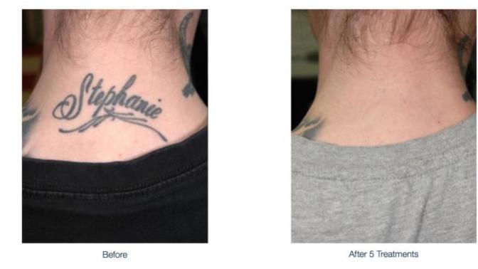 Would you remove a tattoo if your partner asked you to?