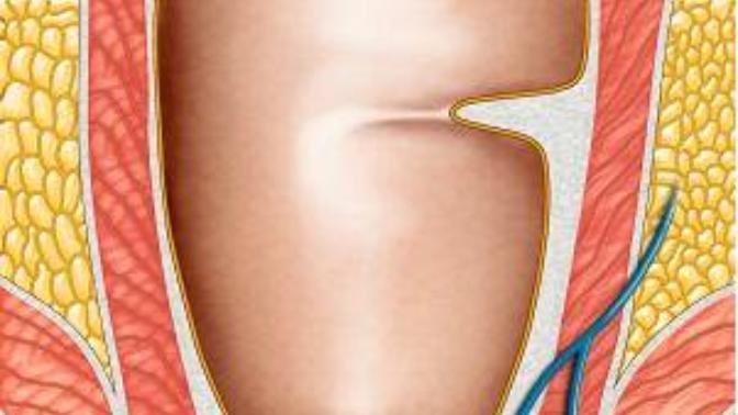Any one with HEMORRHOIDS? What cures or medications do you use?