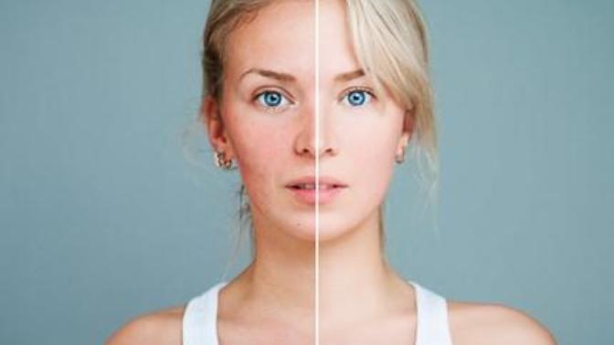 How can I make my acne scars fade?