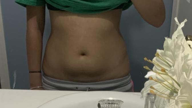 Can you get rid of a belly pouch?