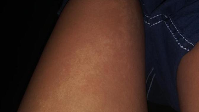 weird white spot on my leg?