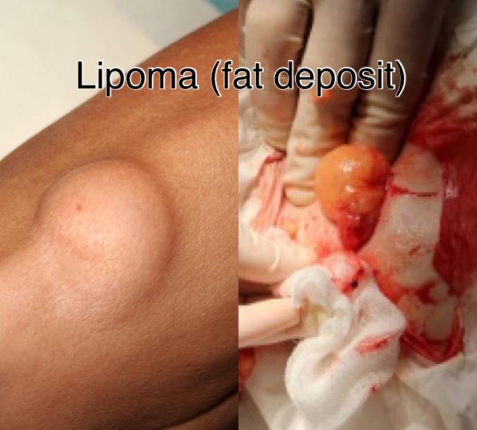 Have You Ever Had A Cyst Or A Lipoma?