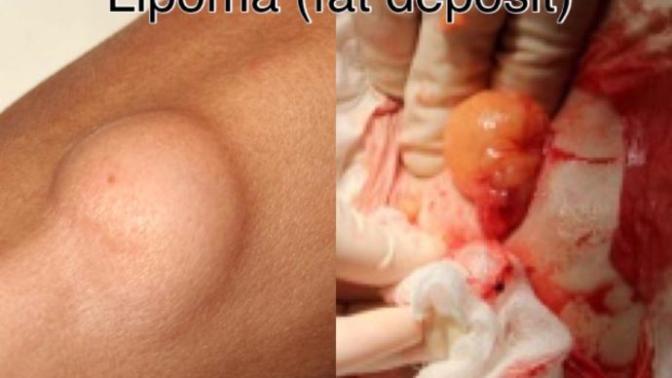 Have You Ever Had A Cyst Or A Lipoma?
